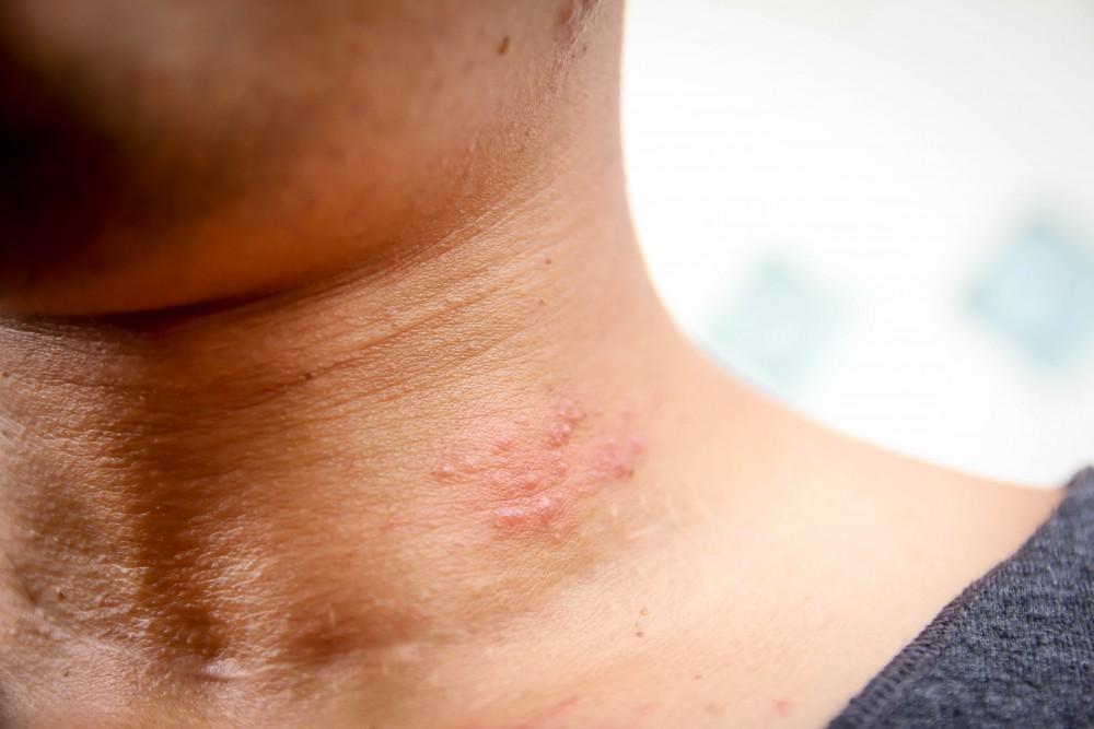Shingles Symptoms Explained Recognizing the Red Flags